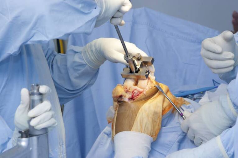 операција на артроза на коленото