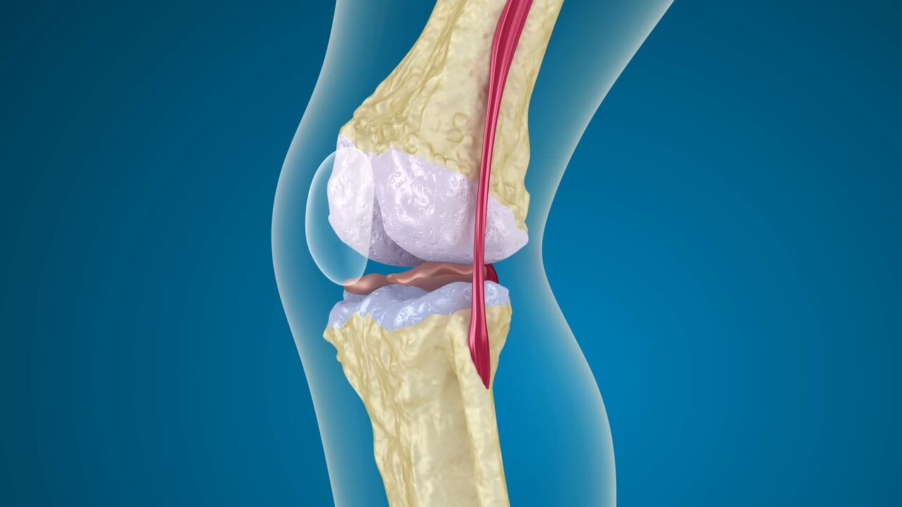 уништување на коленото зглоб со артроза