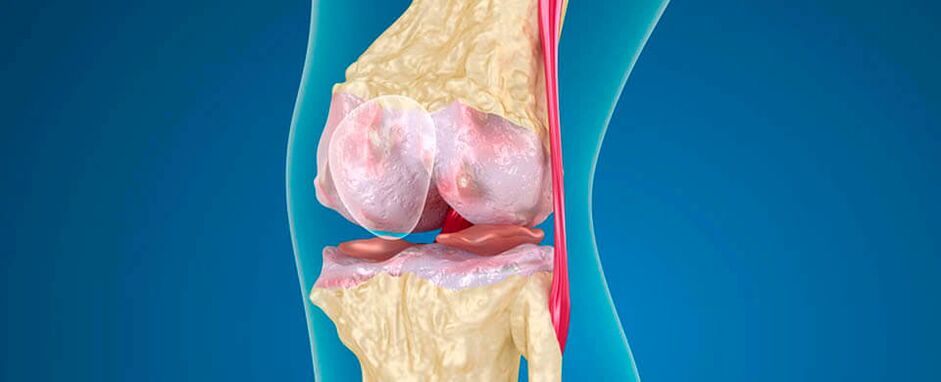 артроза на коленото како причина за болка