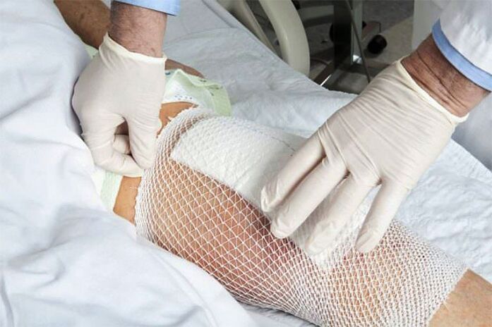 Терапевтски компрес за артроза на коленото зглоб