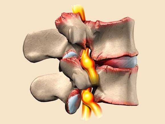 повреда на 'рбетот кај торакална остеохондроза