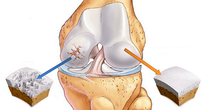 здрава 'рскавица и 'рскавица погодена од артроза