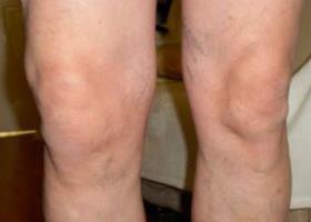 симптоми на колено